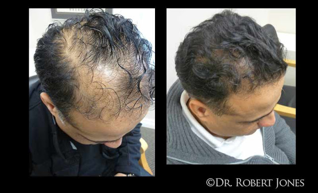One-Year FUE Hair Transplant Results - THTS