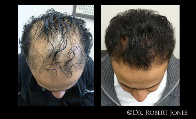  Frontal FUE Hair Transplant Results - THTS