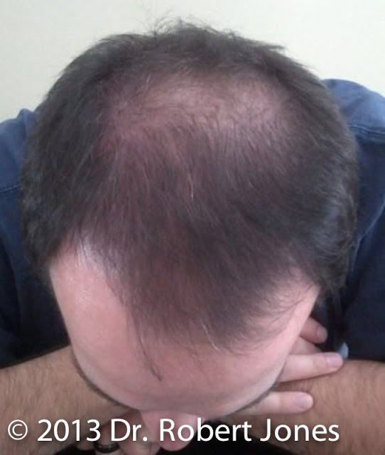 Case Presentation - Hairline and Thinness at Crown Case Presentation - Hairline and Thinness at Crown