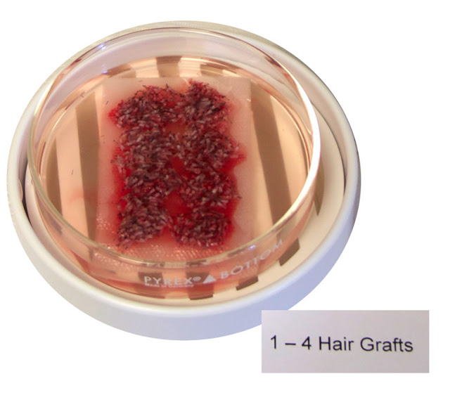 Close Up Grafts for Hair Transplant Close Up Grafts for Hair Transplant