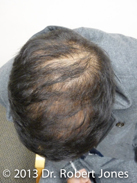 FUE Hair Transplant FUE Hair Transplant