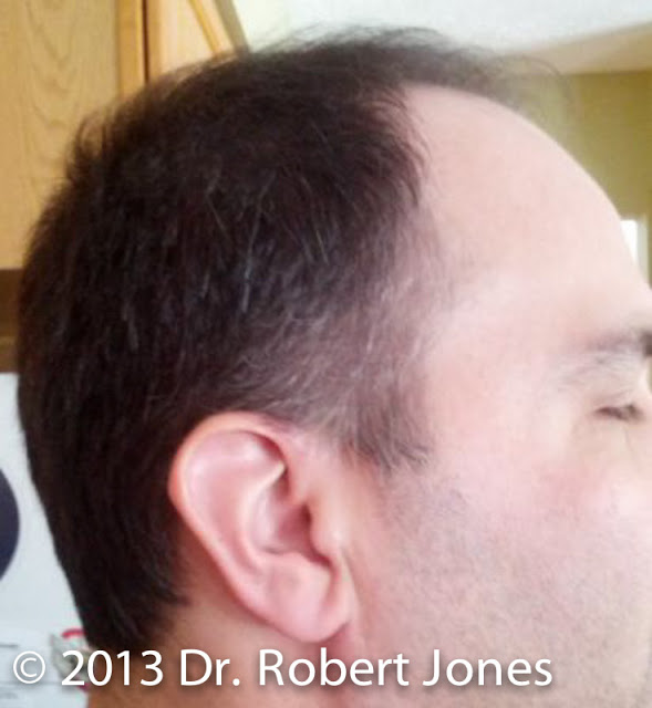 Hairline and Thinness at Crown Hairline and Thinness at Crown