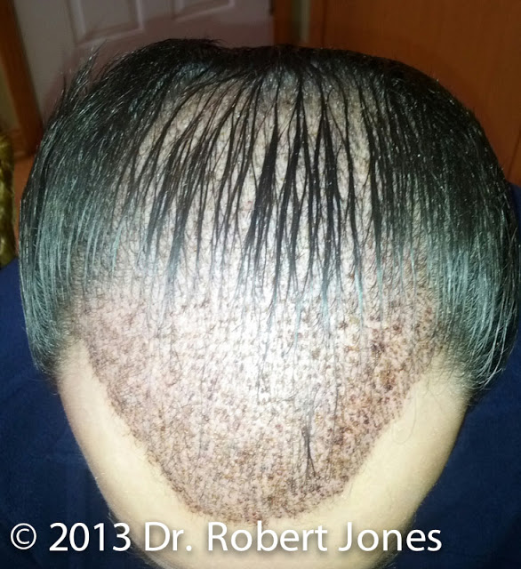 Hairline Treatment - After Surgery Hairline Treatment - After Surgery