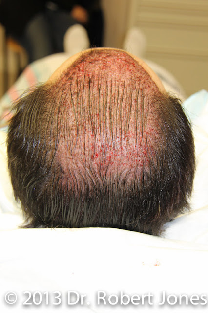 Hairline Treatment - The Results of a Full Day of Surgery Hairline Treatment - The Results of a Full Day of Surgery