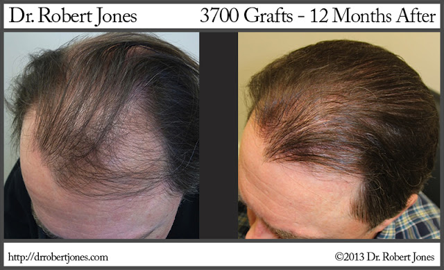 3700 Graft FUE Procedure 3700 Graft FUE Procedure