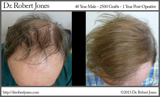48 Year old Male 2500 Grafts