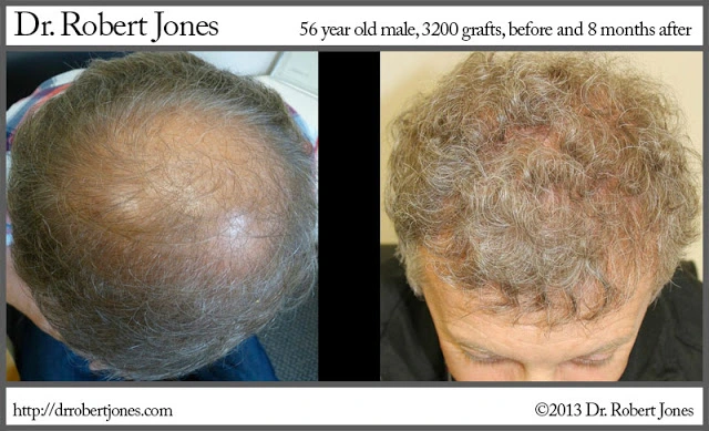 56 Year Old Male 3200 Grafts Strip Surgery 56 Year Old Male 3200 Grafts Strip Surgery