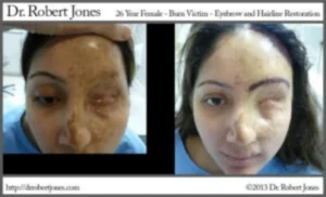 Burn Victims Stunning Eyebrow And Hairline Restoration Burn Victims Stunning Eyebrow And Hairline Restoration