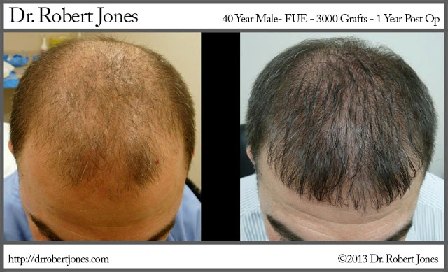 Fue Case Of A 40 Year Old Male Fue Case Of A 40 Year Old Male