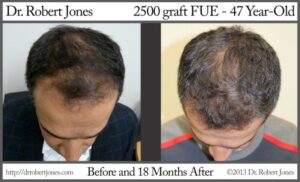 2500 Graft FUE Before and After 2500 Graft FUE Before and After