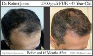 2500 Graft FUE Hairline Reconstruction Before and After 2500 Graft FUE Hairline Reconstruction Before and After