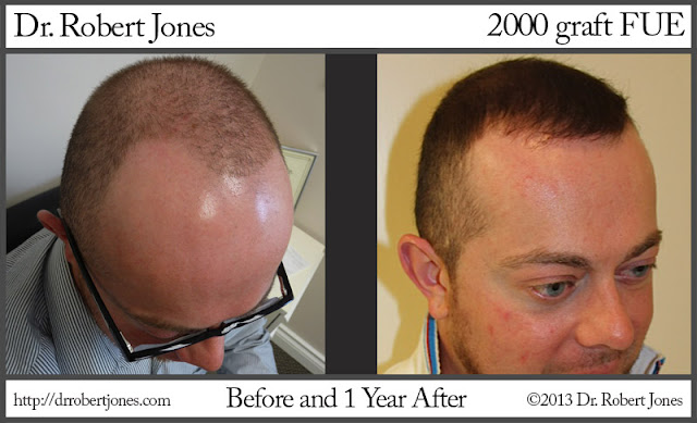 2000 Graft Fue Superslide Template Results