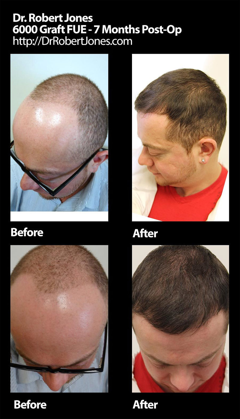 new-casea-6000-fue-grafts-s