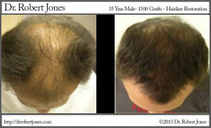 3000-grafts-mega-session-8-mo-post-male-40s-300x199