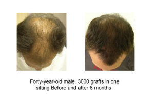 3000-grafts-mega-session-8-mo-post-male-40s-300x199