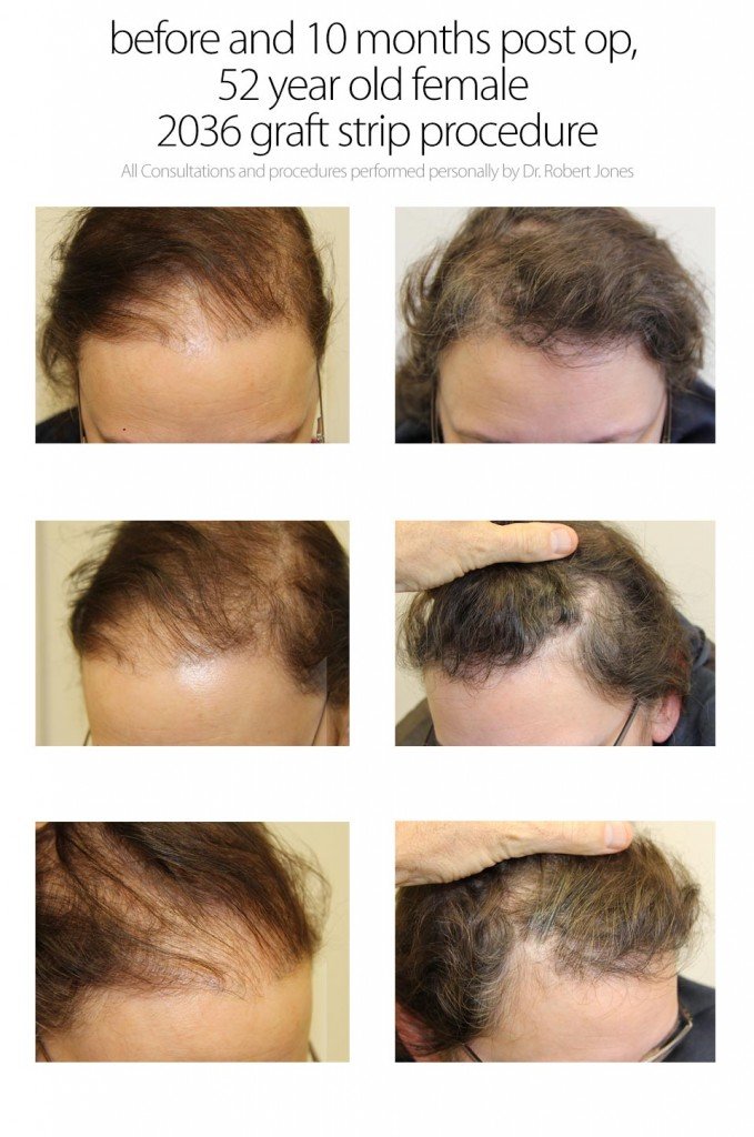 Post OP 2036 Graft Strip Procedure