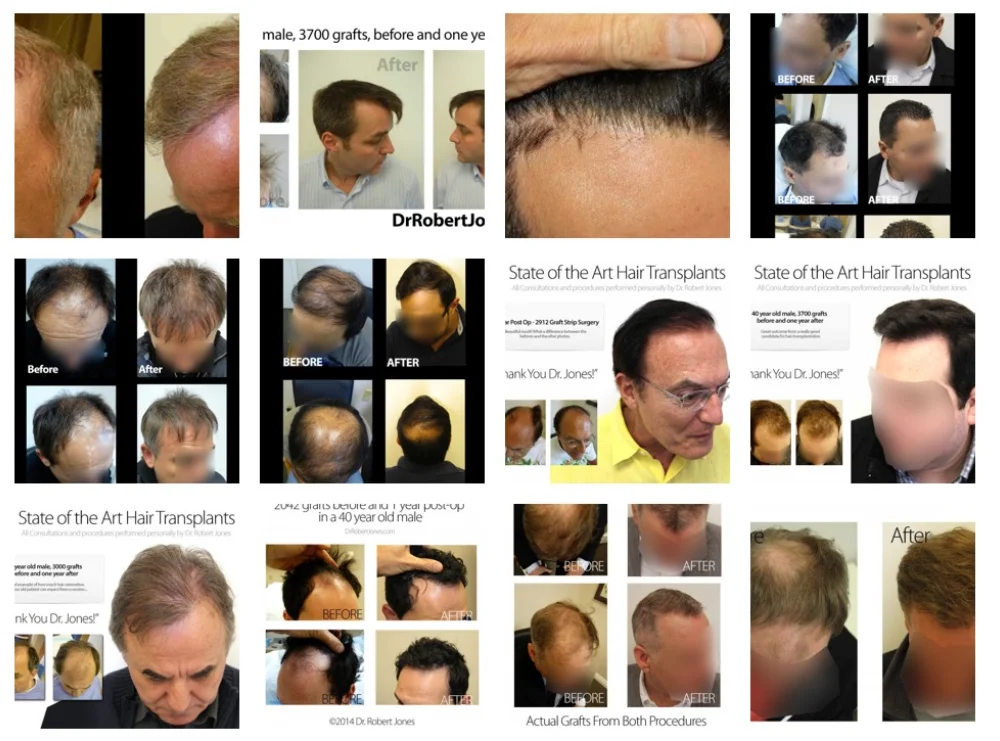 Before And After Age of Grafts Before And After Age of Grafts