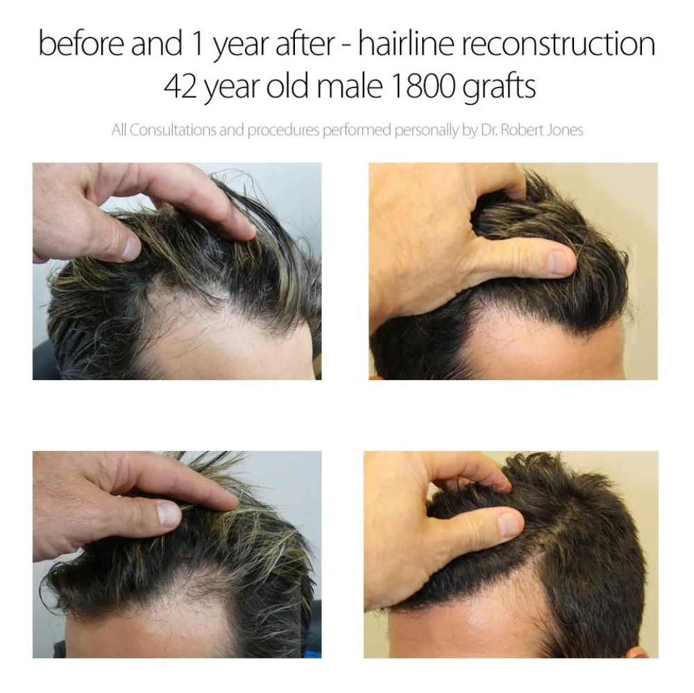 1800 Graft Hairline Reconstruction