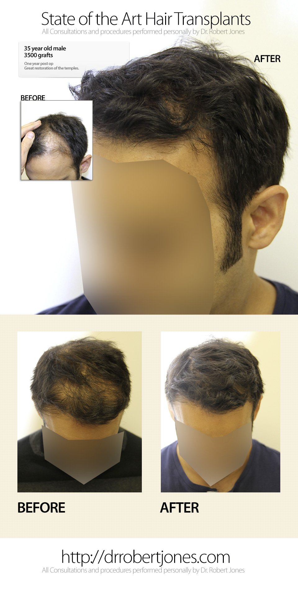 3500 Graft Strip Hair Transplant Surgery 3500 Graft Strip Hair Transplant Surgery