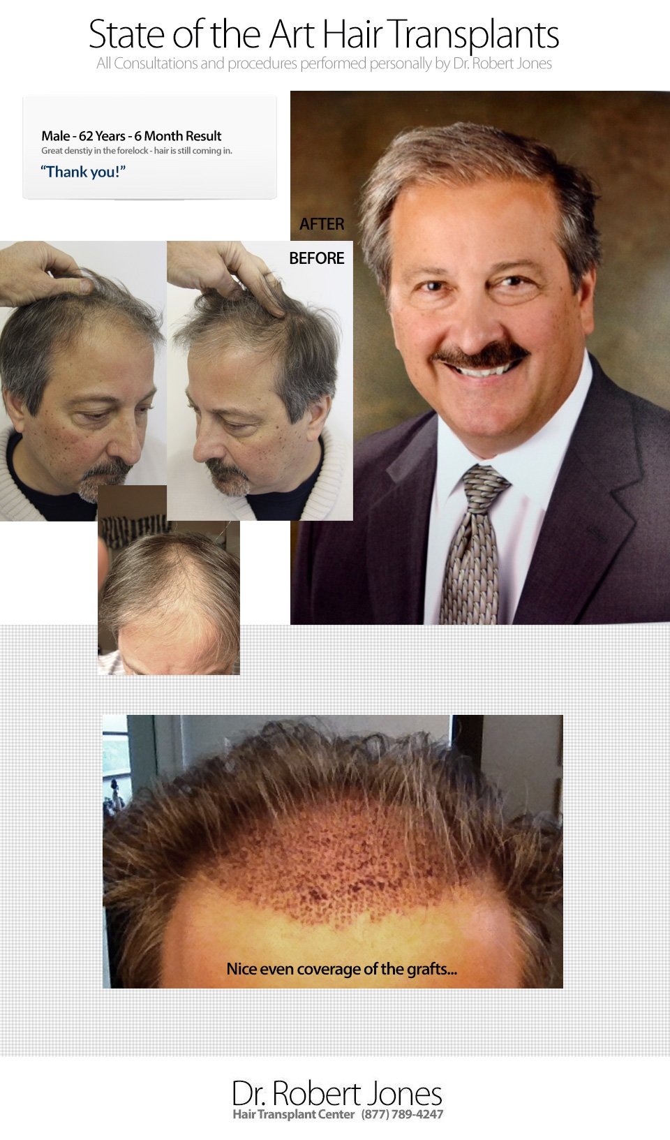 2014-9-17-62yo-male-6-month-post-o-img-1