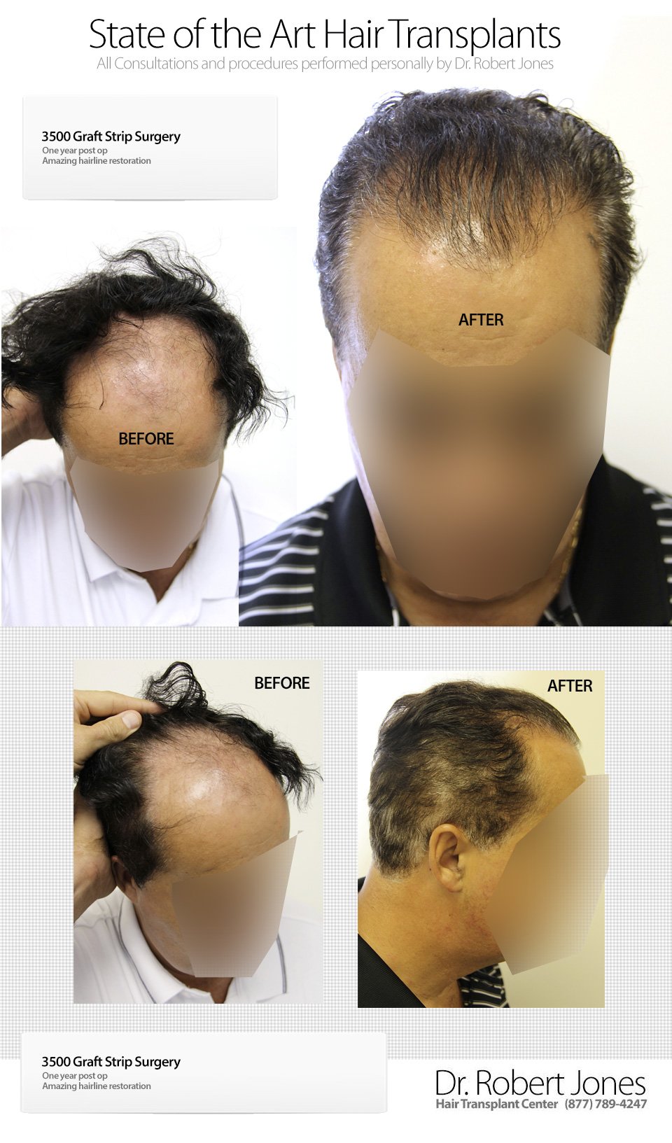2014-9-6-3500-graft-strip-hairline-restoration-img-1
