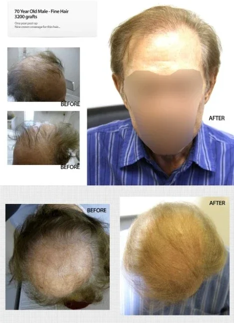 70 Year Old Male 3200 Grafts Fine Hair