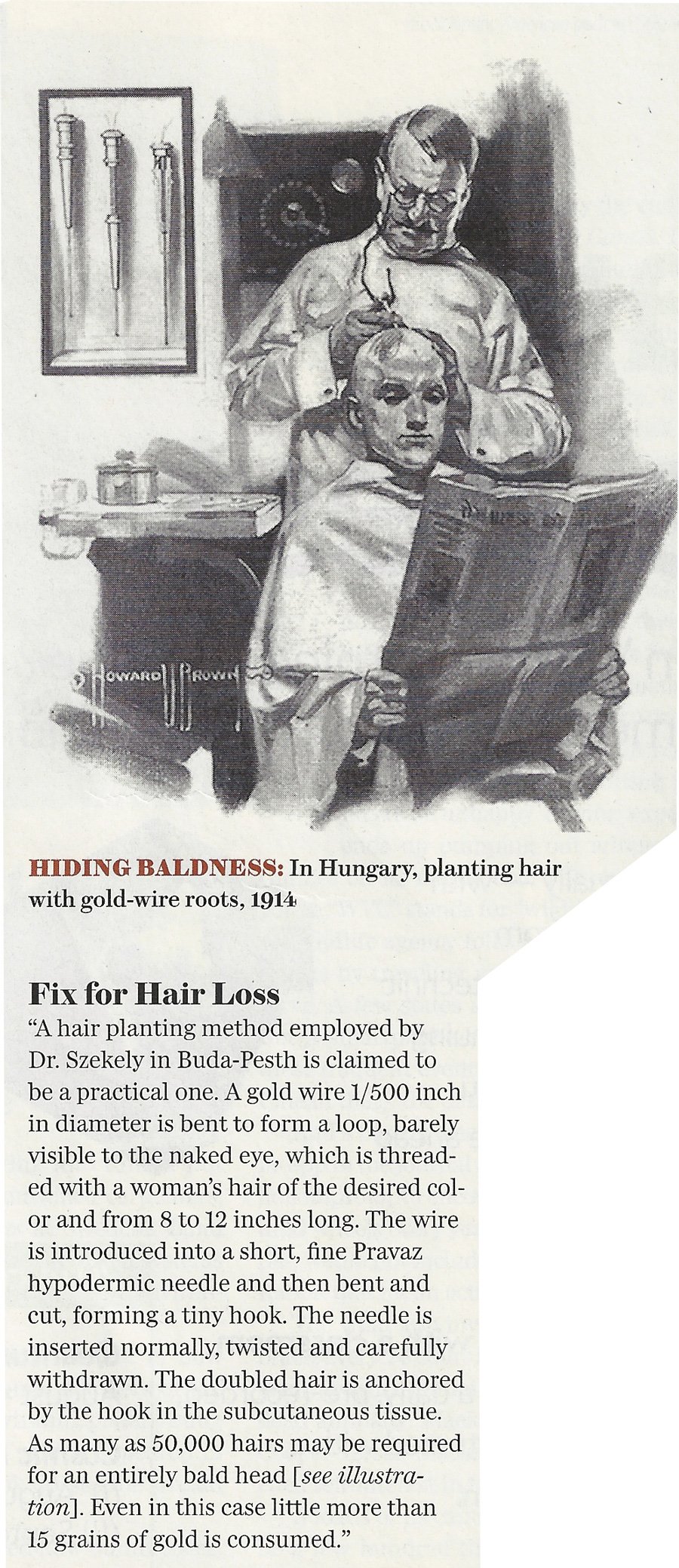Hair Transplants From 100 Years Ago