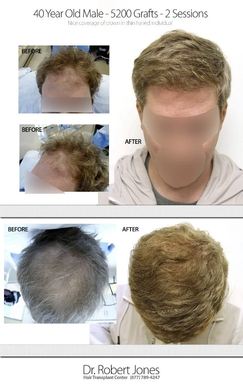 40 Year Old Male 5200 Graft Hair Transplant 40 Year Old Male 5200 Graft Hair Transplant