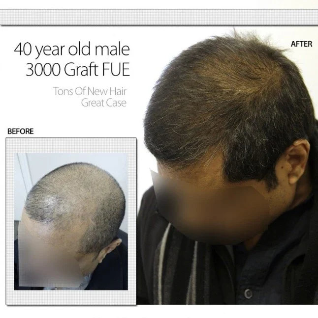 40 Year Old Male 3000 Graft FUE 