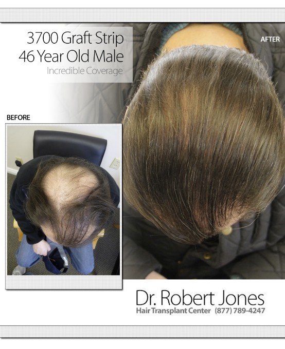 3700 Graft Strip 46 Years Old Before and After 3700 Graft Strip 46 Years Old Before and After