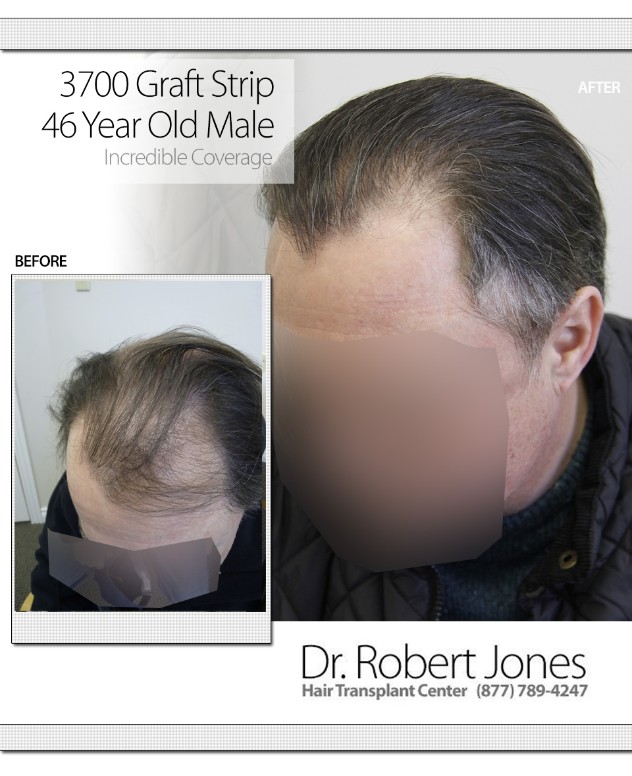 3700 Graft Strip Before and After 3700 Graft Strip Before and After