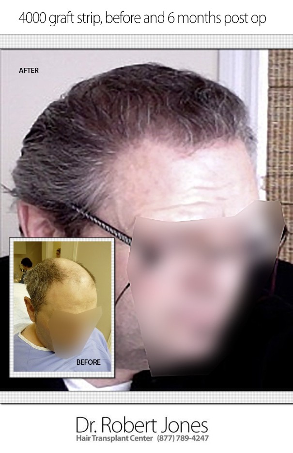 4000 Graft Strip Surgery Before 6 Month After 4000 Graft Strip Surgery Before 6 Month After