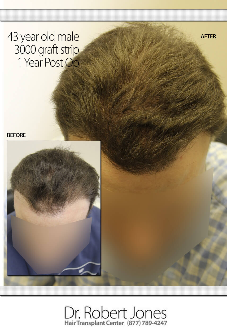 3000-FRONT-GRAFT-STRIP-SURGERY