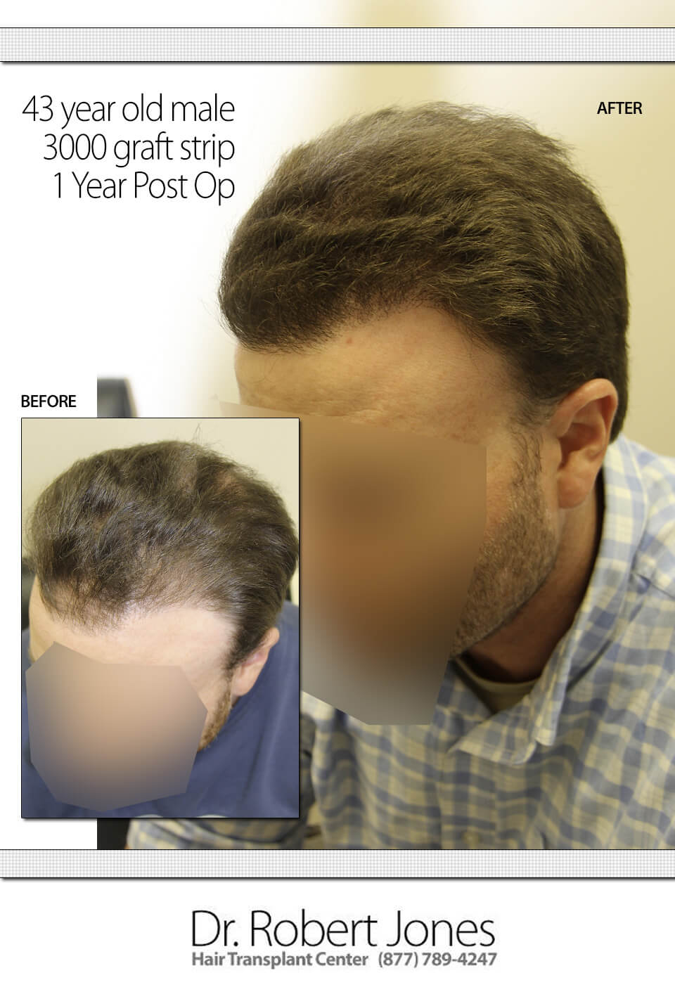 3000-FRONT-GRAFT-STRIP-SURGERY 3000-FRONT-GRAFT-STRIP-SURGERY