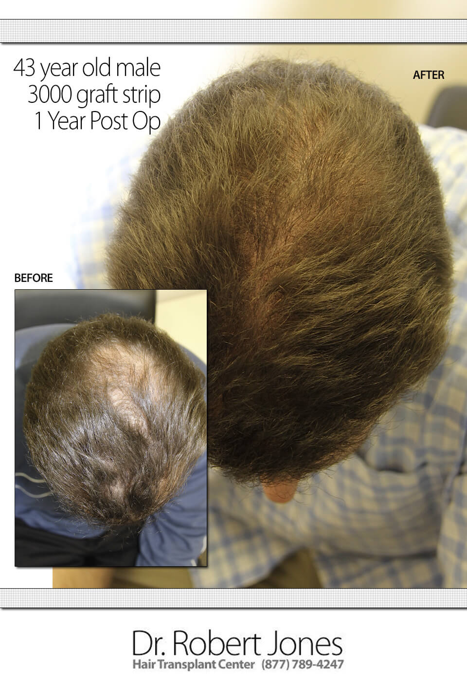 3000-FRONT-GRAFT-STRIP-SURGERY 3000-TOPVIEW-GRAFT-STRIP-SURGERY