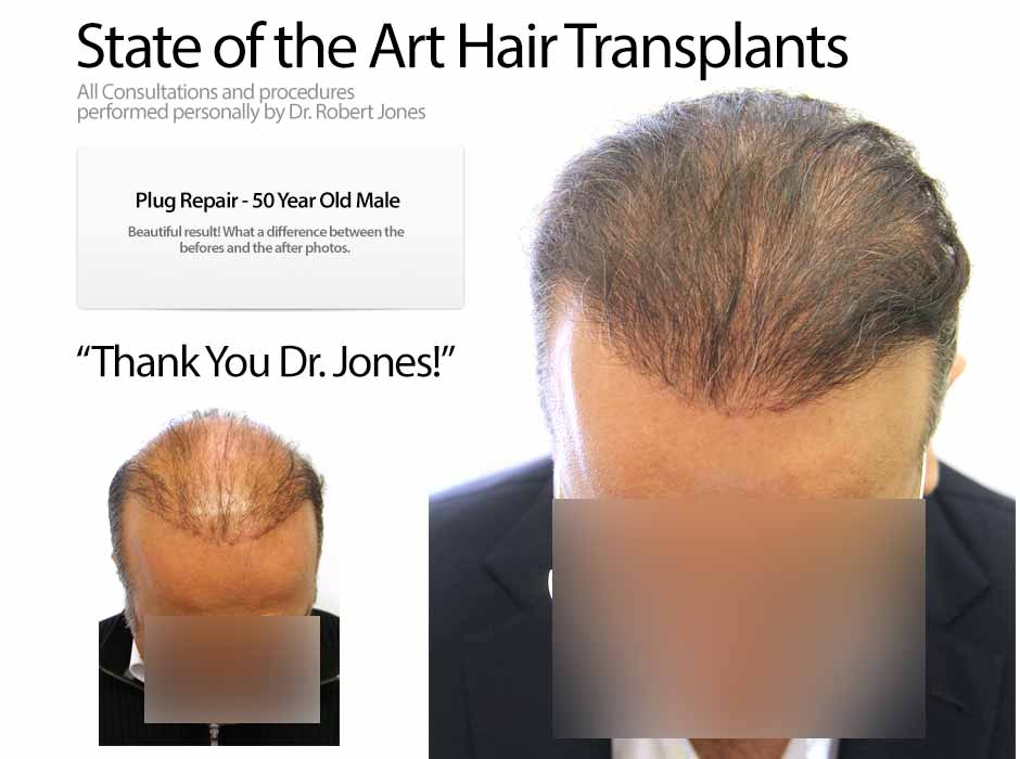 hair transplant