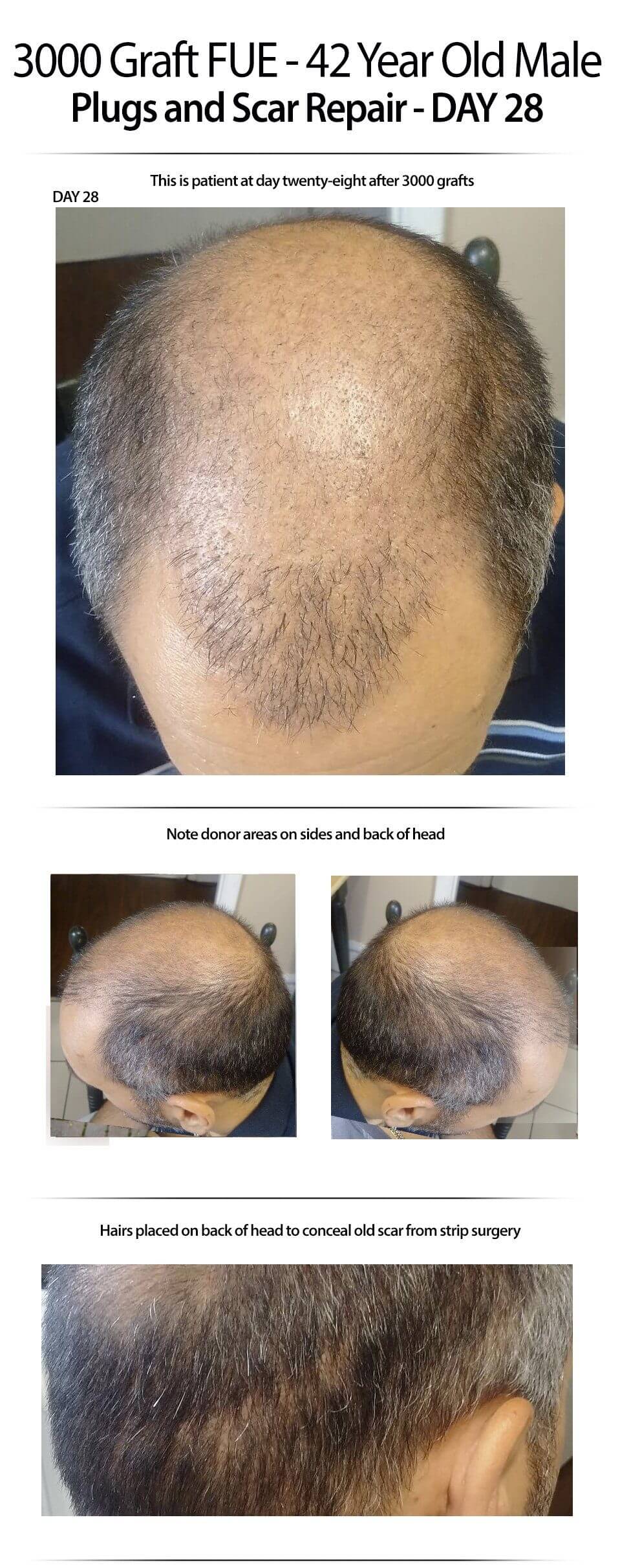 2015-7-9-Day-28-fue-and-scar-repair-img-1-1