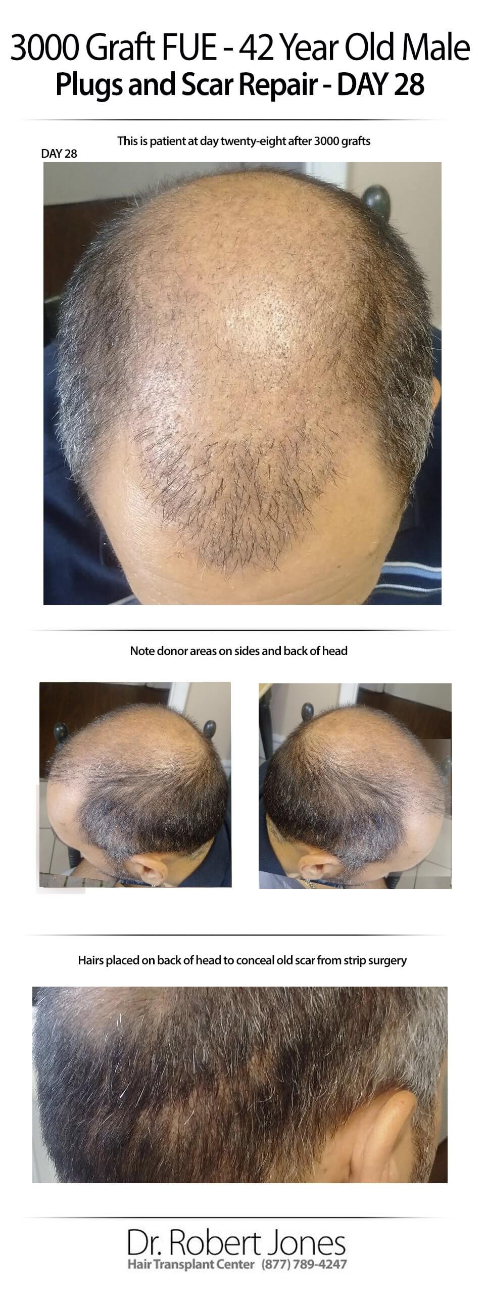 2015-7-9-Day-28-fue-and-scar-repair-img-1