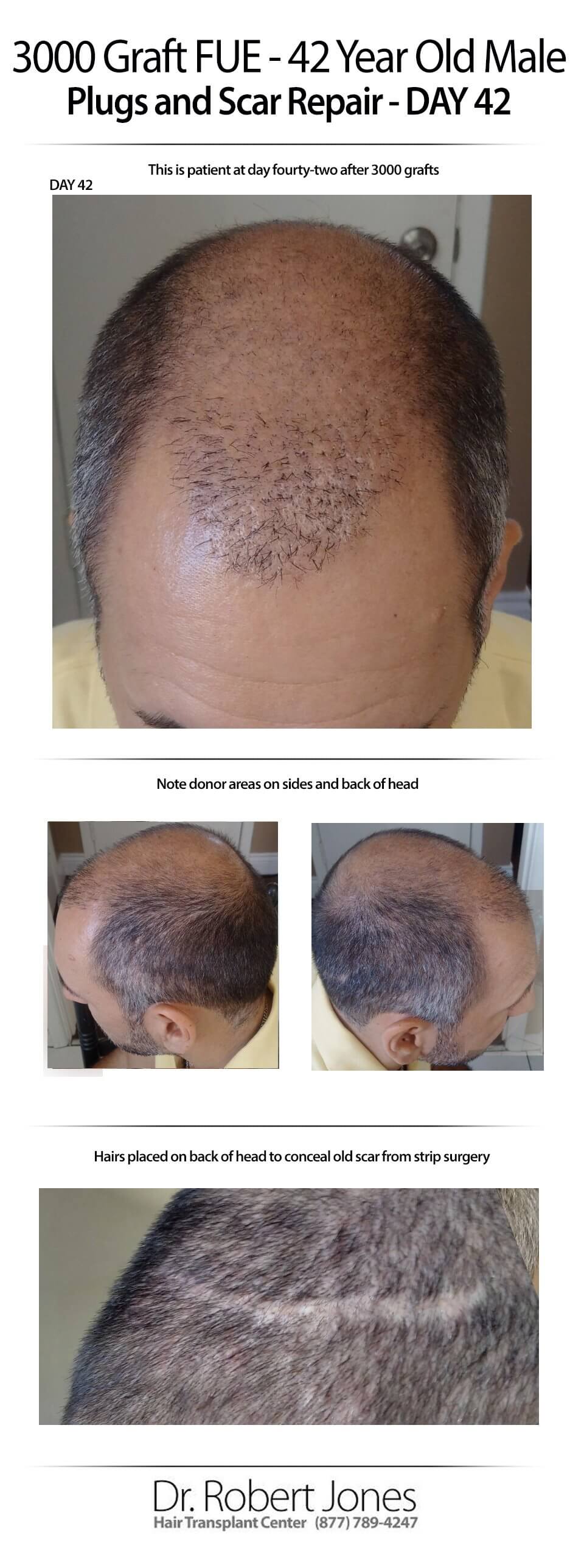 2015-7-9-Day-42-fue-and-scar-repair-img-1