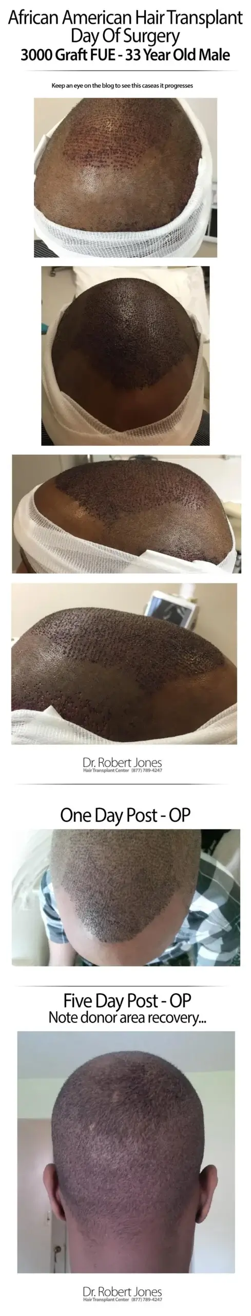 African American 3000 Graft FUE African American 3000 Graft FUE