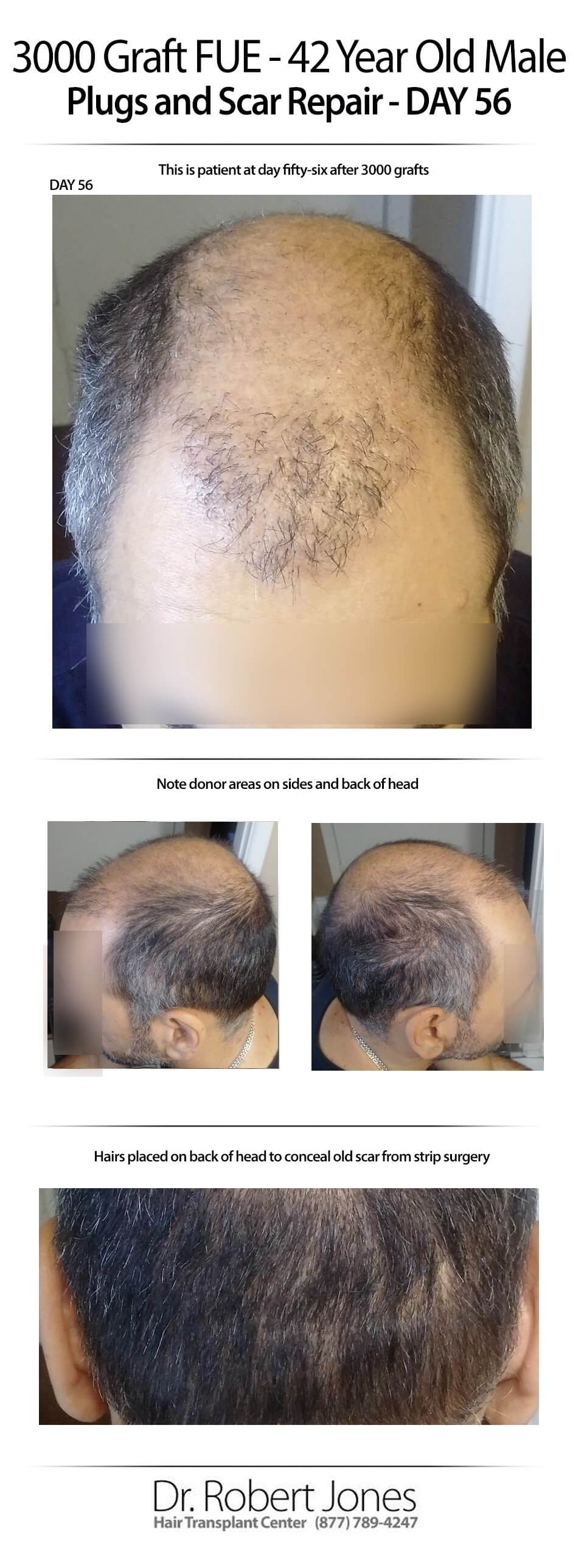 2015-7-9-Day-56-fue-and-scar-repair-img-1