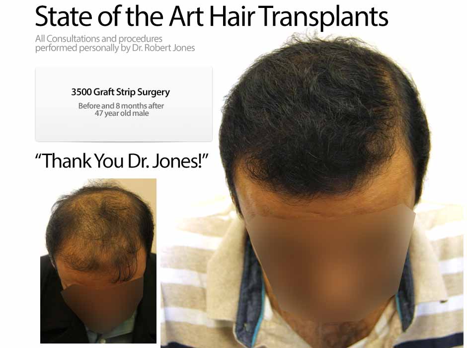 2015-9-2-3500-graft-strip-47-yo-male
