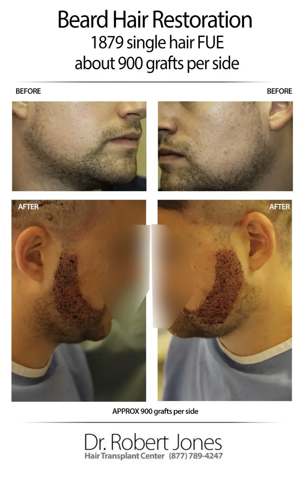 Beard Transplant 1800 Grafts Day Of Surge Beard Transplant 1800 Grafts Day Of Surge