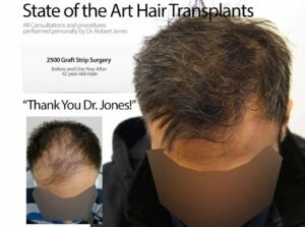 2500 Graft Strip Surgery Before And After 2500 Graft Strip Surgery Before And After
