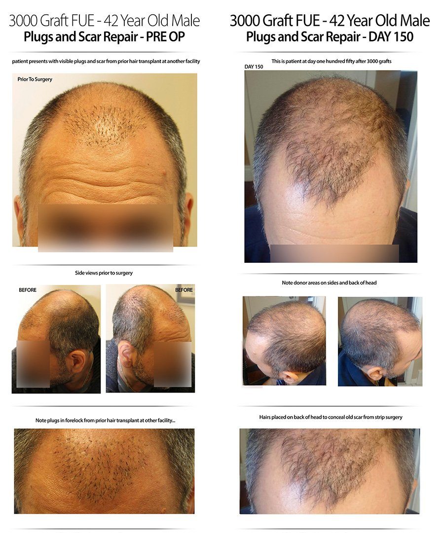 2015-11-11-pre-op-day-150-3000-graft-plug-repair-img-2