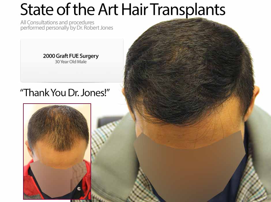 2015-11-3-2000-graft-fue-30-year-old-front-male