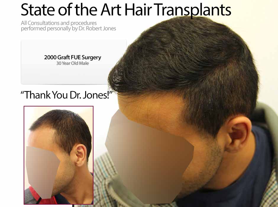 2000 Graft FUE Surgery 30 Yr Male