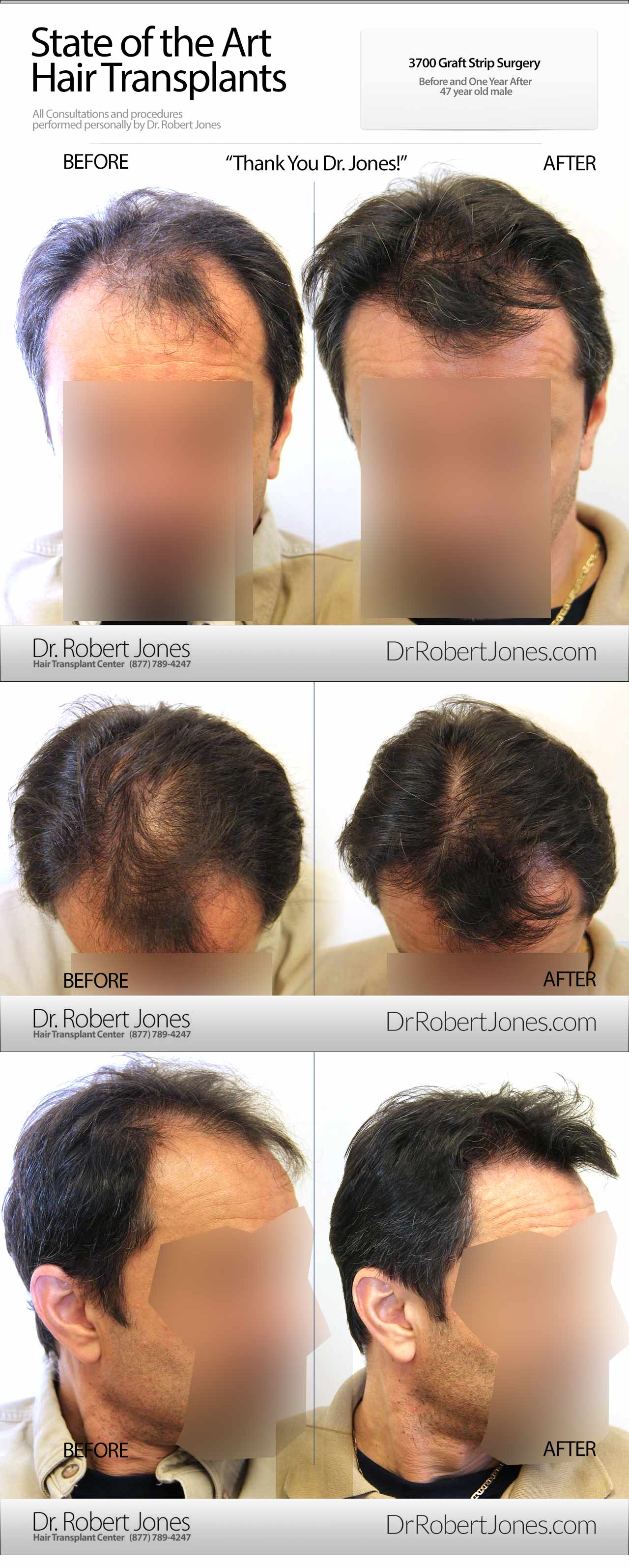 Strip-Surgery -3700-Grafts Strip-Surgery -3700-Grafts