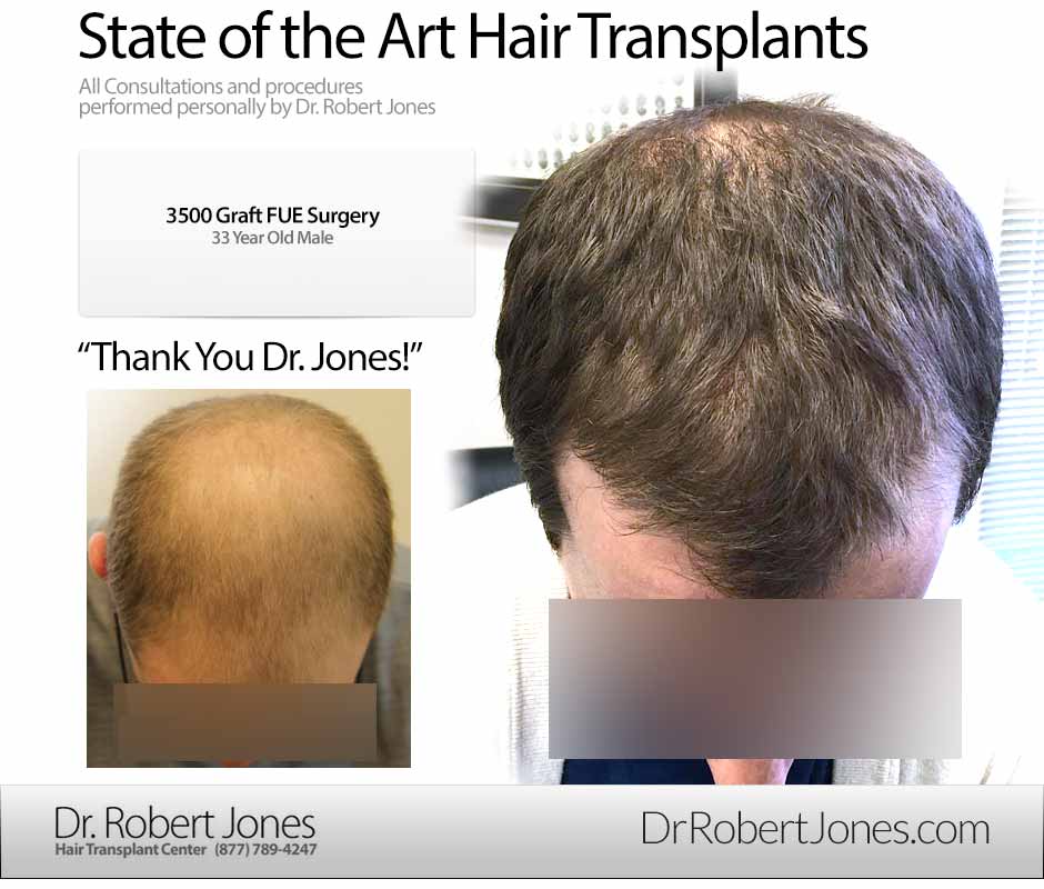 3500 Graft FUE 23 Year Old Before After