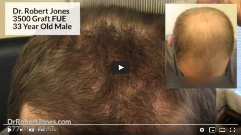 3500 Graft FUE - 33 Year Old Male